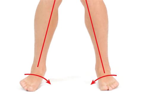 A Breakdown of Pronation Distortion Syndrome