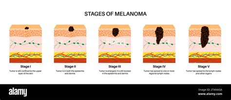 Melanoma stages, illustration Stock Photo - Alamy