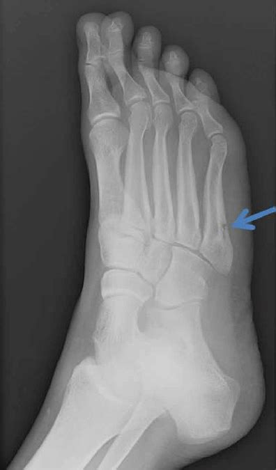 Xray Of Foot Stress Fracture