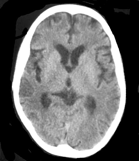 Neurosyphilis in the modern era | Journal of Neurology, Neurosurgery & Psychiatry