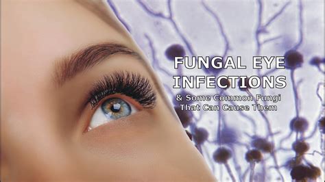 Fungal Eye Infections and Some Common Fungi That Can Cause Them - Memphis Mold Inspector