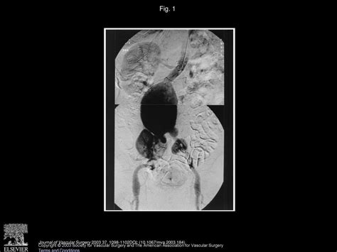 Abdominal aortic aneurysm associated with crossed renal ectopia without fusion: Case report and ...