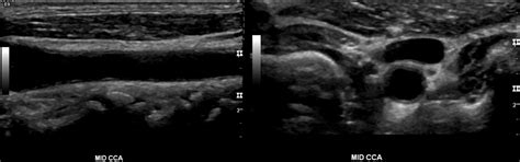 Carotid duplex protocol