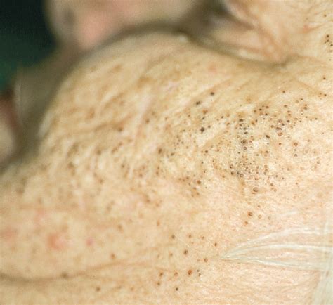 Collection of Skin Disorders: Melanomas to Moles | Consultant360