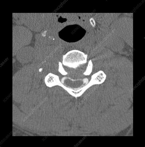 Cervical Myelogram CT - Stock Image - C027/1644 - Science Photo Library