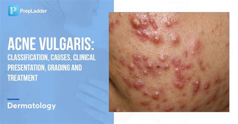 Acne Vulgaris: Classification, Causes, Clinical Presentation, Grading and Treatment