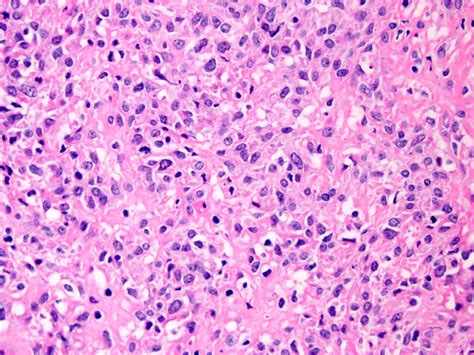 Sclerosing epithelioid fibrosarcoma – Blog | PathologyOutlines.com