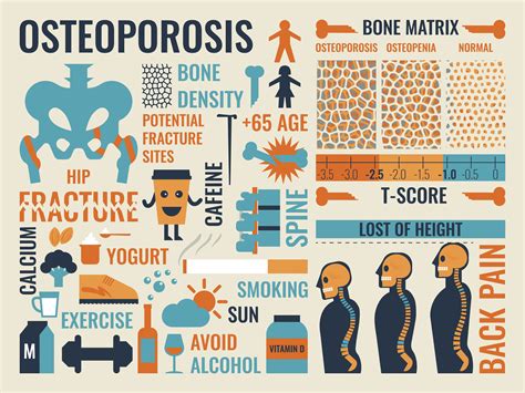 Osteoporosis 545439 Vector Art at Vecteezy