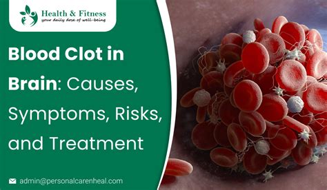 Blood Clot in Brain: Causes, Symptoms, Risks, and Treatment - PersonalcareNheal