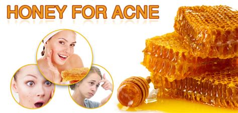 Honey for Acne - Best Alternate Remedy to Cure Scars