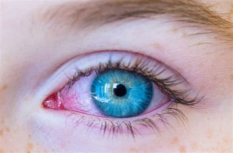 What Can Cause Red Eyes in a Child?｜Calgary