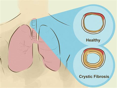 Out of Breath? How to Recognize & Diagnose Lung Hyperinflation