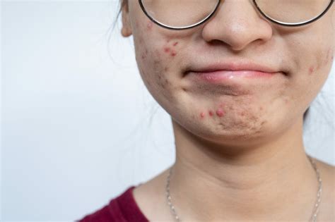 Treating Teenage Acne - Dermatology Advisor