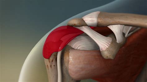 Shoulder Bursitis