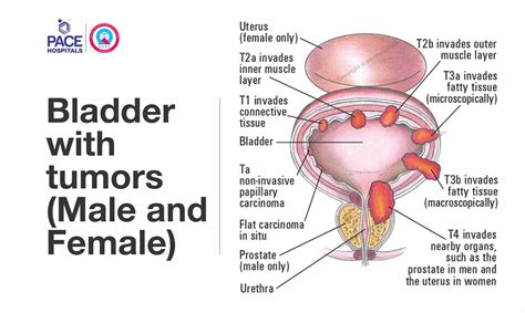 Transurethral Resection of Bladder Tumour (TURBT)