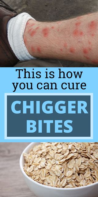 15 Best Home Remedies To Treat Chigger Bites - wellness magazine