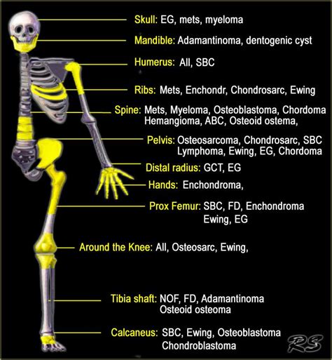 Bone tumor - Systematic approach and Differential diagnosis | Radiology technician, Nuclear ...