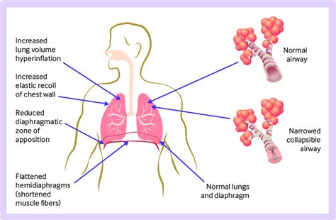 | Pathophysiology of hyperinflation and benefits of non-invasive... | Download Scientific Diagram