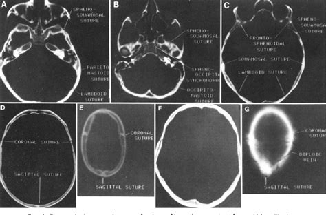 Figure 6 from Computerized tomography of cranial sutures. Part 1 ...