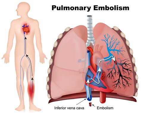 Predictive Model for Pulmonary Embolism Risk in Lung Cancer | Docwire News