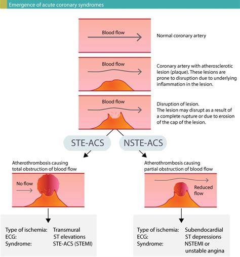 Classification of Acute Coronary Syndromes (ACS) & Acute Myocardial Infarction (AMI) – ECG learning