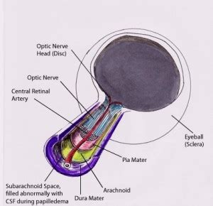 Papilledema Pictures, Symptoms, Causes, Treatment