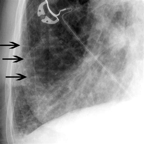 Heart Failure (HF) - Cardiovascular Disorders - MSD Manual Professional ...