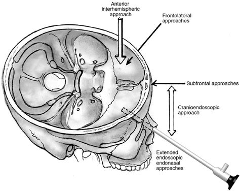 Anterior Skull Base Surgery | Neupsy Key