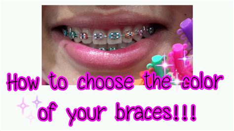 How to choose the color of your braces!!! - YouTube