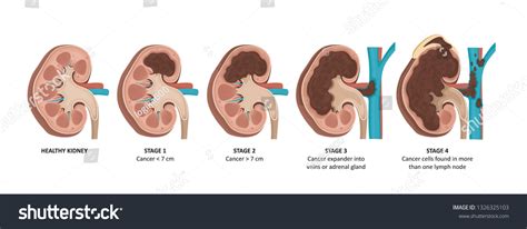 Kidney cancer stages. - Royalty Free Stock Vector 1326325103 - Avopix.com