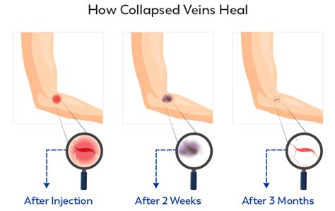 What is a collapsed vein? » Ask Our Doctors (by JourneyPure)