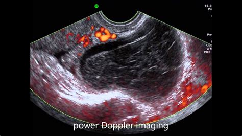 Hemorrhagic Ovarian Cyst - Scan Of A Person Having Hemorrhagic Ovarian Cyst - YouTube