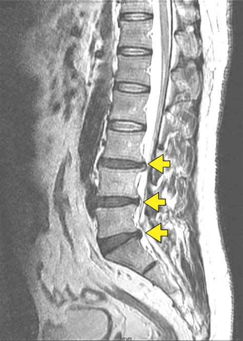 Lumbar Disc Disease Mri