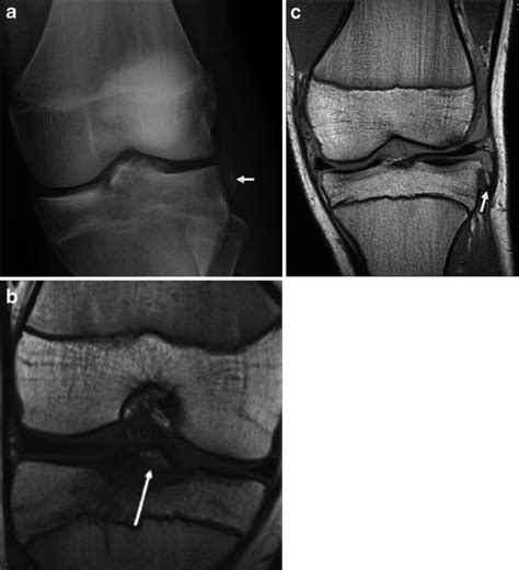 Tibial spine avulsion and Segond fracture. The arrow points to Segond... | Download Scientific ...