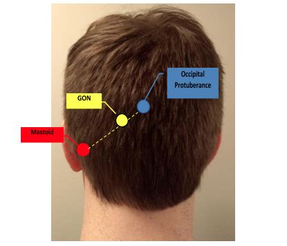 Occipital Nerve Block Reviews - mapasgmaes