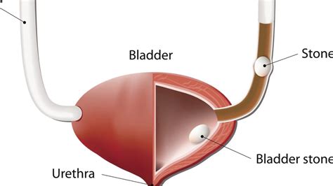 What Are Bladder Stones? - YouTube