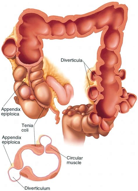 Colon Diverticulosis Overview - Dr Anastasios Christodoulou