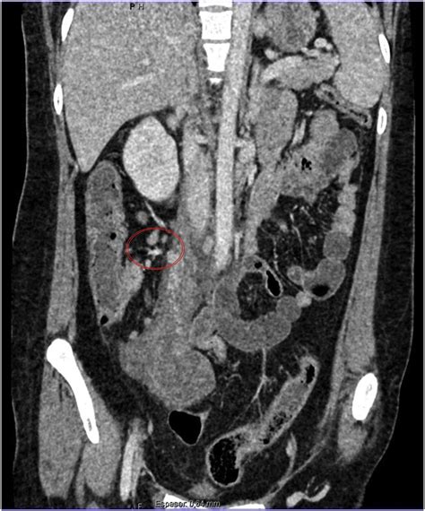 Abdominal CT scan with IV contrast in coronal plane. Enlarged right... | Download Scientific Diagram