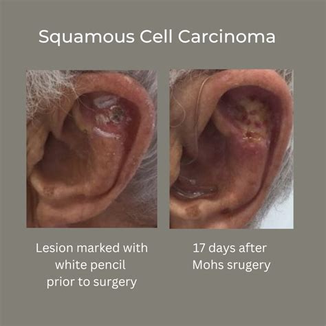 Squamous Cell Carcinoma Treatment: Common and Curable