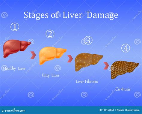 Stages of Liver Damage, Liver Disease. Healthy, Fatty, Liver Fibrosis and Cirrhosis on Blue ...