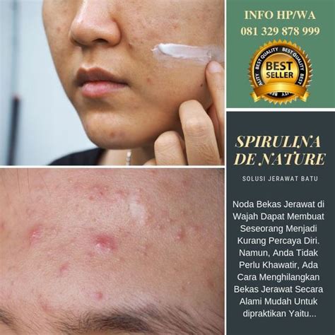 9+ Cara Hilangkan Jerawat Pasir Di Dahi Dengan Cepat For You