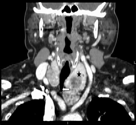 Dyspnea in multinodular goiter: a case report of substernal multinodular goiter complicated with ...