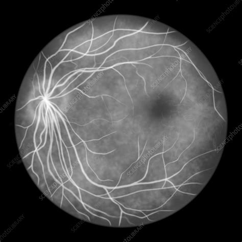 Fluorescein angiogram of a healthy retina, illustration - Stock Image - F036/4325 - Science ...