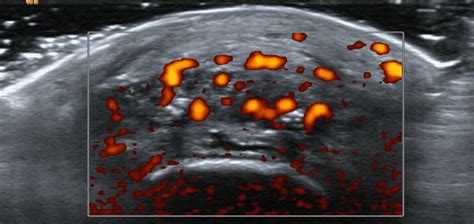 Erosions on ultrasound →