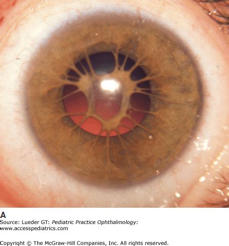 Disorders of the Iris and Pupil | Ento Key