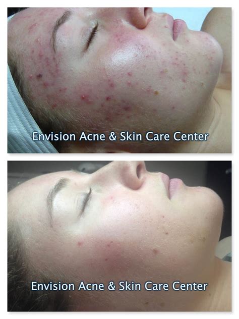 Before & After Skin Care & Acne Treatment Client Examples