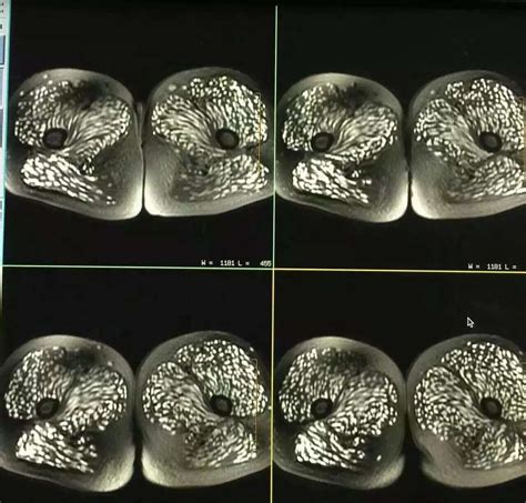 Young Woman's Body & Brain Riddled With Parasitic Worms & Cysts - After ...