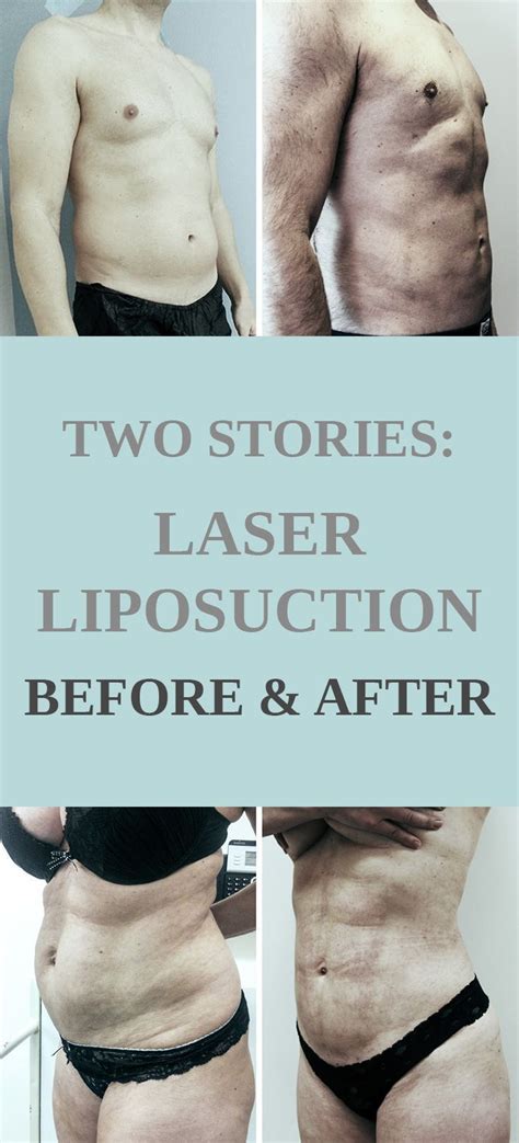 Two Stories: Laser Liposuction Before and After - #Laser #Liposuction # ...