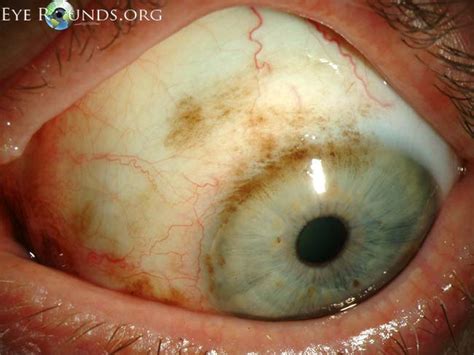 Atlas Entry - Primary acquired melanosis (PAM)