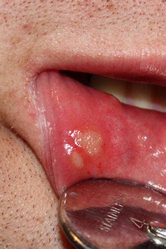 Etiopathogenesis of Recurrent Aphthous Stomatitis and the Role of Immunologic Aspects ...